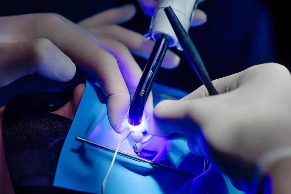 Close-up of a dental treatment: a hand-held UV light source cures a light-curing adhesive on a tooth, violet-blue light illuminating the joint